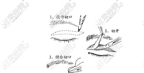 庫爾勒奧蕊斯整形醫(yī)院雙眼皮手術(shù)圖