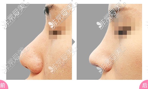 韩国隆鼻手术对比图