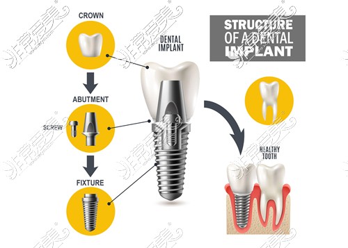 种植牙组成部分