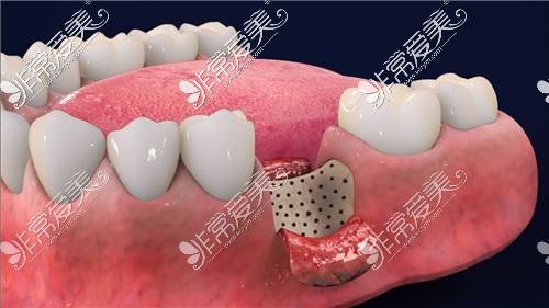 种植牙植骨