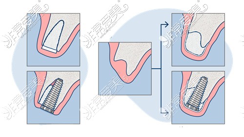 骨量缺失植骨后种植