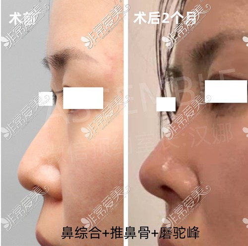 韩国德丽珍整容外科鼻综合术前术后图片