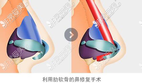 韩国4月31日整形外科肋软骨隆鼻修复展示