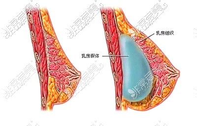 揭秘乌鲁木齐隆胸假体多少钱?另附乌市假体隆胸好的医院