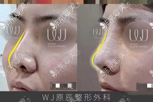 韩国WJ原辰整形：鼻修复手术