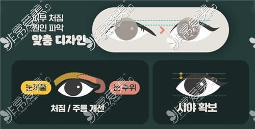 韩国WJ原辰眼睛整形怎么样?上下眼睑矫正和天使眼都不错!
