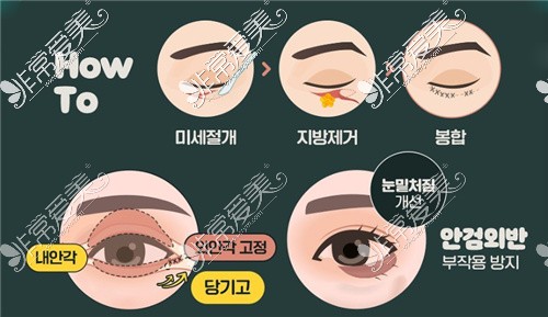 韩国WJ原辰整形下眼睑手术改善