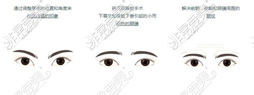 韩国WJ原辰整形天使眼手术可以改善的眉眼形态