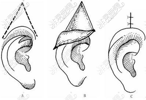 耳朵整形手术