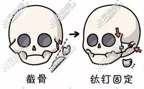 颧骨手术固定方式图