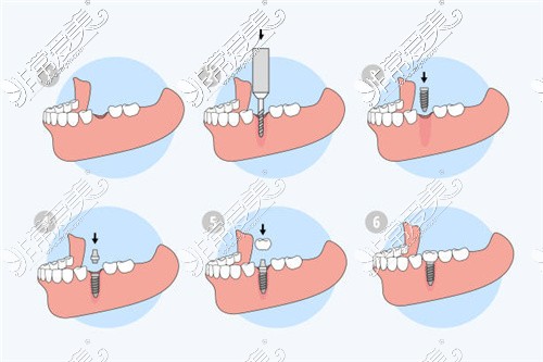 种植牙步骤