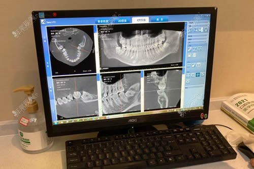深圳潔芽口腔牙齒治療CT圖片拍攝