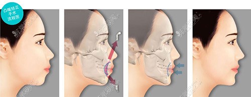突嘴矫正示意图