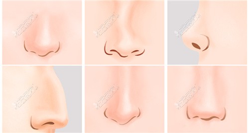 常见各类型鼻子问题