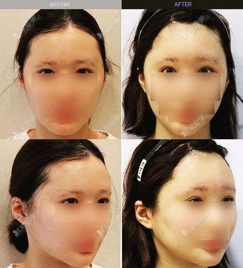 韩国lara整形外科双眼皮