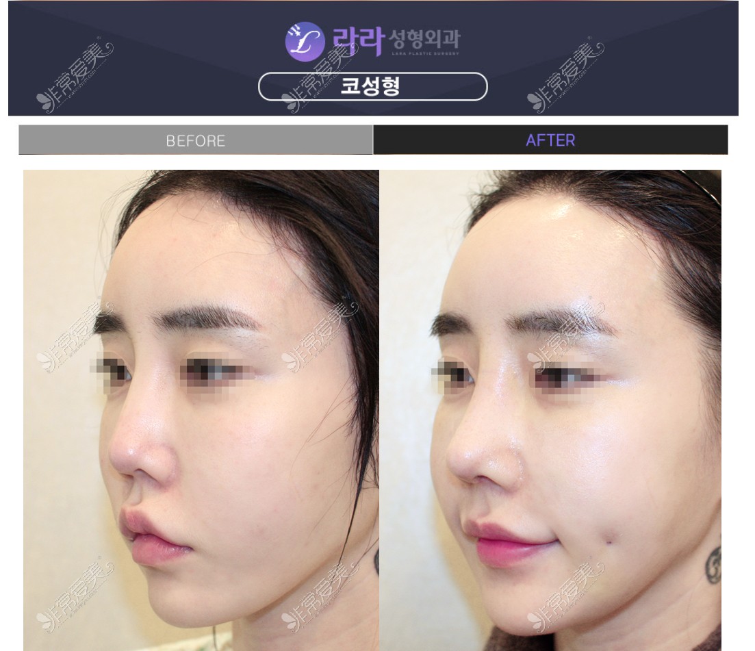韩国Lara整形外科隆鼻