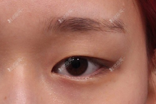 为什么韩国割双眼皮那么自然？韩国VG百利酷双眼皮全过程！