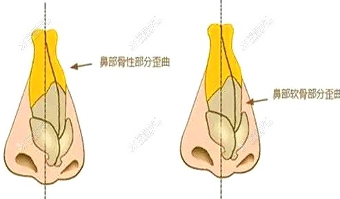 乌鲁木齐华美整形医院鼻子整形图