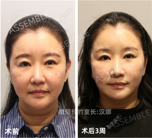 韩国德丽珍整容外科拉皮手术对比