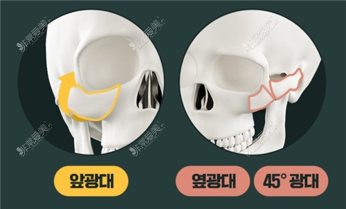 韩国WJ原辰整形外科轮廓缩小手术