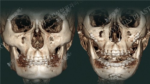 韩国WJ原辰整形外科颧骨缩小前后对比