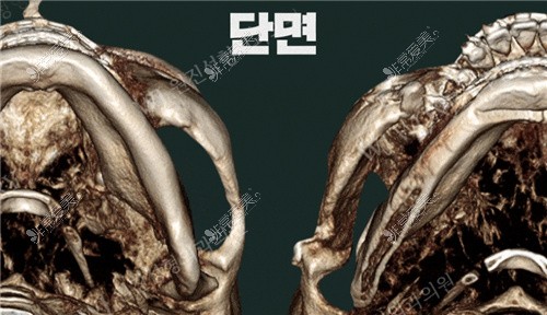 韩国WJ原辰整形外科颧弓部缩小前后差异