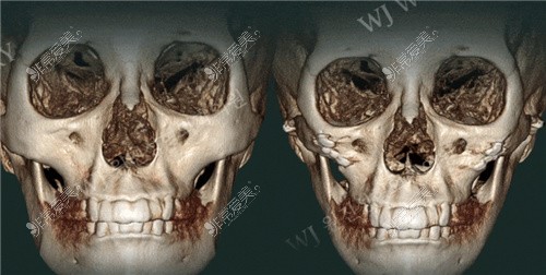 韩国WJ原辰整形外科颧骨缩小差异巨大