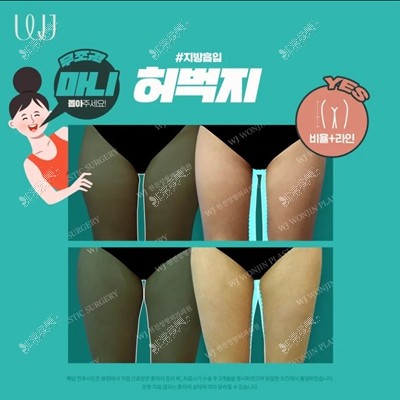 韩国WJ原辰医院大腿吸脂对比