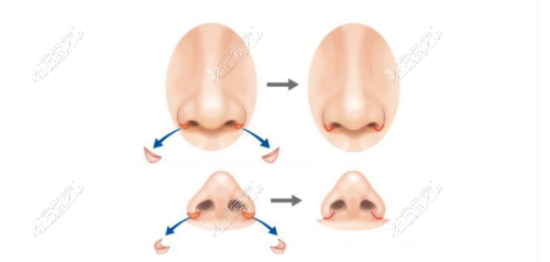 鼻翼缩小手术示意图