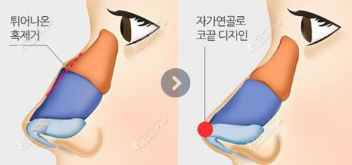韩国4月31日整形外科鼻修复特点分析