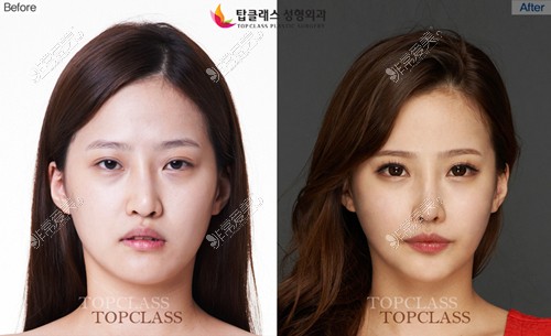 韩国topclass医院官网鼻子整形图片对比女