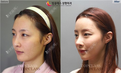韩国Topclass整形外科鼻整形前后