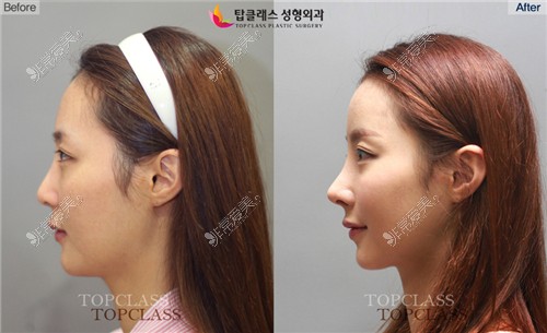 韩国Topclass整形外科鼻整形对比照