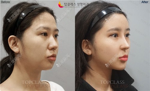 韩国topclass整形外科鼻整形术后