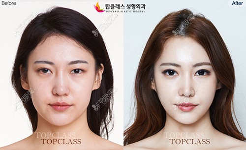 韩国Topclass整形外科术前术后对比