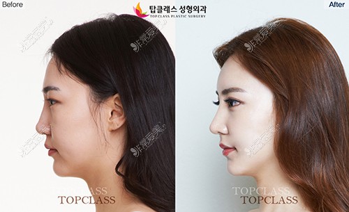 韩国Topclass整形外科术前术后对比