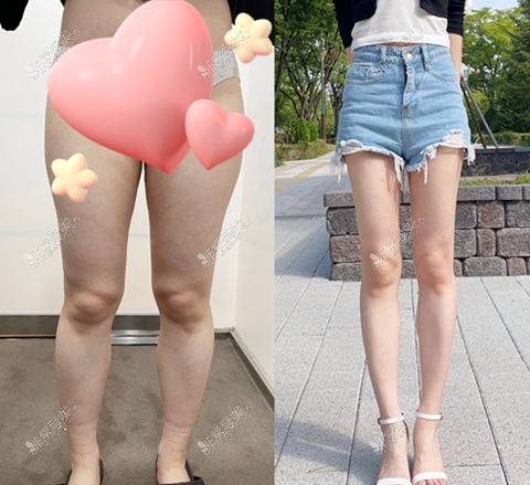 韩国365mc医院大腿抽脂术前术后对比照