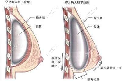 隆胸假体植入层次示意图