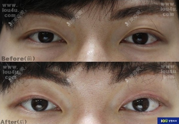 韩国IOU整形外科双眼皮手术