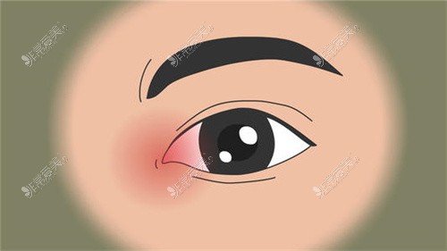 关于韩国佰诺佰琪整形医院眼部修复手术三个细节，收藏！