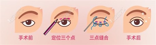 关于韩国佰诺佰琪整形医院眼部修复手术三个细节，收藏！