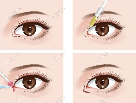 眼角整形手术动画图