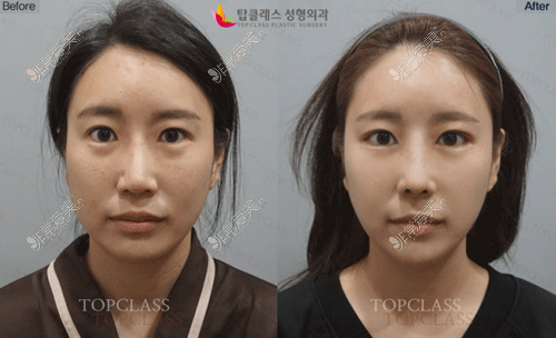 韩国topclass鼻子手术图片