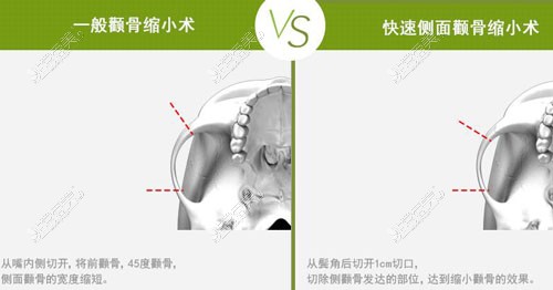 韩国4月31日整形外科颧骨缩小手术特点分析