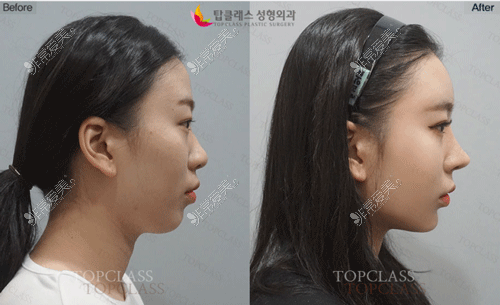 韩国topclass整形图片鼻子手术前后