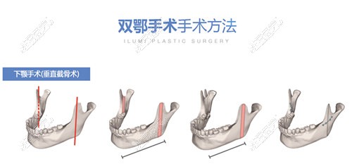 韩国一路美颌面整形技术剖析！含双颚/突嘴/反颌手术方式！