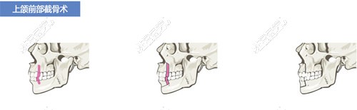 上颌前部截骨术步骤示意图