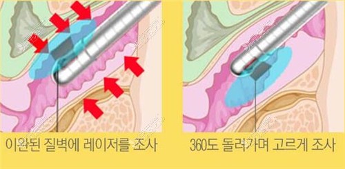 韩国葡萄女性医院激光阴道紧缩操作图