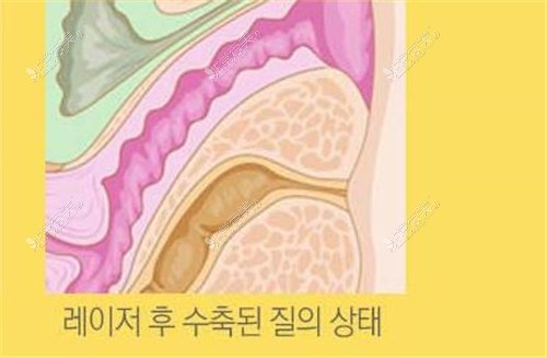 韩国葡萄女性医院激光阴道紧缩术后疗效示意图