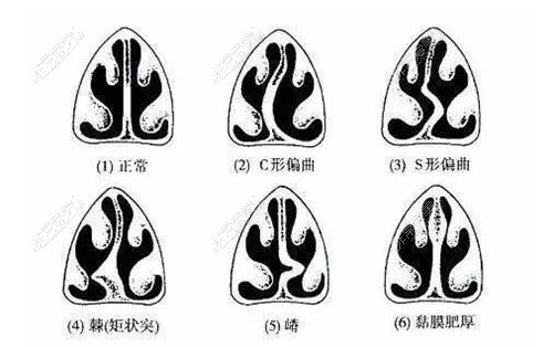 鼻中隔歪曲示意图